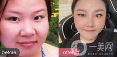 蒜頭鼻整形圖片 蒜頭鼻整形多少錢？