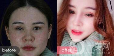 注射隆鼻整形多少要錢？微整形注射隆鼻過(guò)程