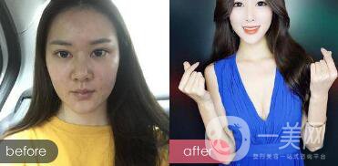 注射隆鼻整形多少要錢？微整形注射隆鼻過(guò)程