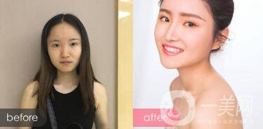注射隆鼻整形多少要錢？微整形注射隆鼻過(guò)程