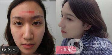 歪鼻整形痛嗎？歪鼻矯正圖片