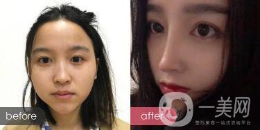 歪鼻整形痛嗎？歪鼻矯正圖片