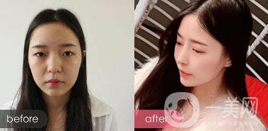 成都綜合隆鼻多少錢？綜合隆鼻真人案例