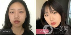 成都開眼角多少錢呢？開眼角案例