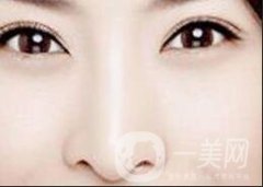 駝峰鼻整容：關(guān)于矯正駝峰鼻的方法和注意事項(xiàng)