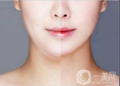 面部吸脂恢復(fù)多久？面罩戴多久？