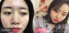 果酸祛痘*果嗎 果酸祛痘有什么好處？