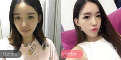 墊下巴前后圖：成都?jí)|下巴整形攻略