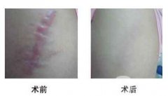 像素激光去疤痕有用嗎？術(shù)后護(hù)理三要點(diǎn)