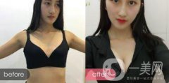 我適合做隆胸嗎 假體會放在什么位置 手術(shù)風(fēng)險大不大？