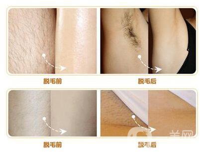 什么是激光脫毛？激光脫毛的優(yōu)勢有哪些？