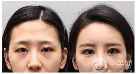 成都打去皺紋針多少錢(qián)呢