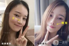 成都鼻翼縮窄多少錢？鼻翼縮小照