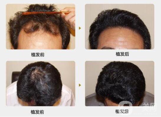 什么是植發(fā)手術(shù)？脫發(fā)的主要原因？