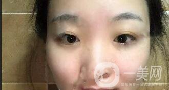 開眼角價格