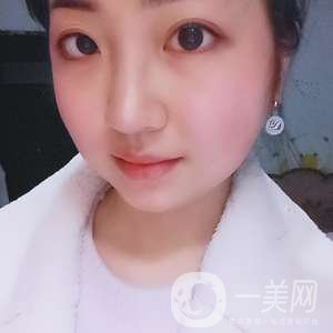 去頰脂墊瘦臉、