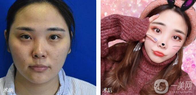 磨顴骨前后照片分享介紹 真人案例 33天就看見*果！