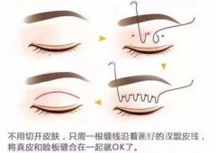 北京埋線雙眼皮修復(fù)價(jià)格盤(pán)點(diǎn)