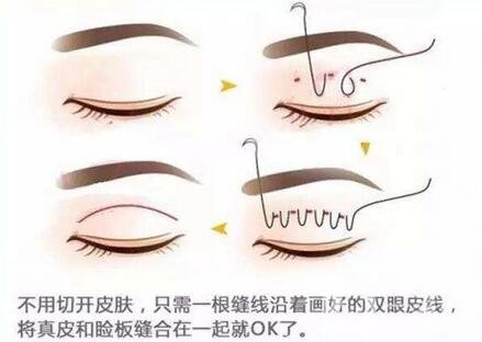 北京埋線雙眼皮修復(fù)價(jià)格盤(pán)點(diǎn)