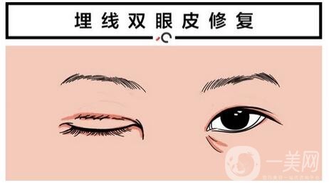 北京埋線雙眼皮修復(fù)價(jià)格盤(pán)點(diǎn)