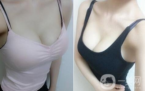 假體隆胸術有哪些特點？