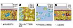 負(fù)壓吸脂果和水動力一樣嗎?哪個更好?
