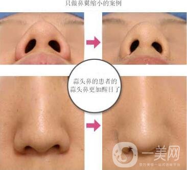 鼻翼縮小手術(shù)恢復過程