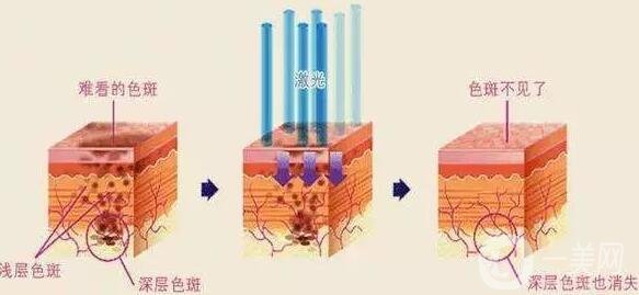 激光祛痘注意事項(xiàng)有哪些？