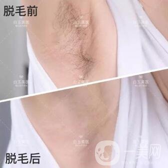 激光脫毛手術(shù)要多少錢一次？