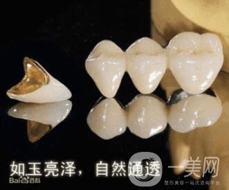 烤瓷牙的種類和優(yōu)缺點分別是什么呢？