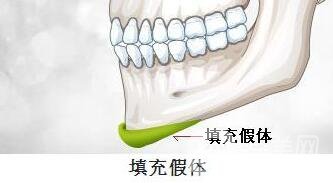硅膠墊下巴要疼幾天？如何緩解這種疼痛感？