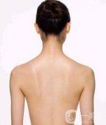 后背吸脂1000毫升多嗎？有明X的瘦背果嗎？