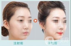 玻尿酸豐太陽要幾支才夠？