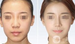 鼻翼縮小術(shù)費(fèi)用大概是多少？