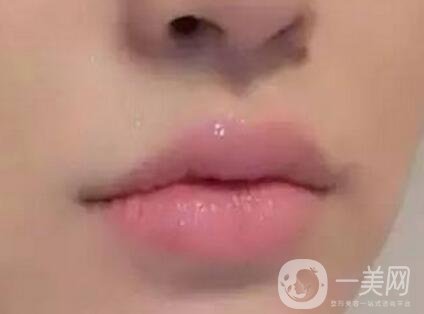 玻尿酸豐唇術 