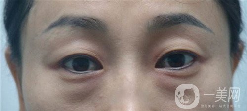 激光去眼袋的價(jià)格多少？要打幾次？