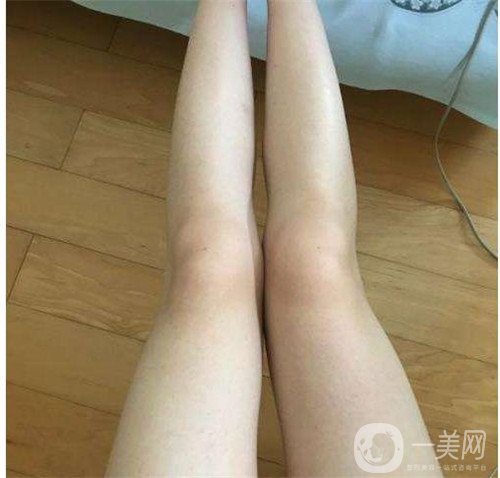 激光溶脂瘦大腿疼嗎？可以忍受嗎？