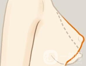 乳房下垂矯正后會反彈再次下垂嗎？術(shù)后穿什么內(nèi)衣？