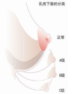 乳房下垂矯正后會反彈再次下垂嗎？術(shù)后穿什么內(nèi)衣？