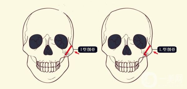 顴骨內(nèi)推和磨骨之間的區(qū)別是什么？哪個*果好些？
