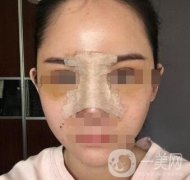 隆鼻固定膠帶幾天去掉？術(shù)后6天去掉會(huì)不會(huì)太早？