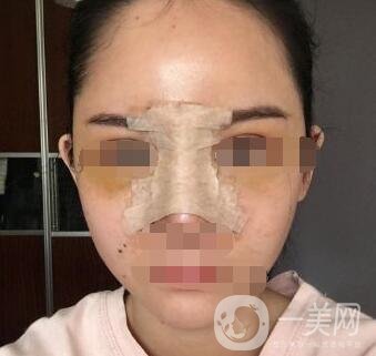 隆鼻固定膠帶幾天去掉？術(shù)后6天去掉會(huì)不會(huì)太早？