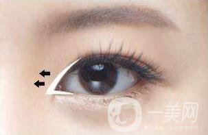 開(kāi)眼角眼睛會(huì)變大嗎？眼睛會(huì)變長(zhǎng)嗎？