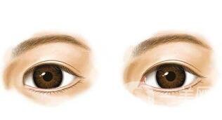 開(kāi)眼角要多少錢(qián)？單獨(dú)開(kāi)眼角價(jià)格貴不貴？