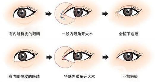 開眼角前后照片圖，放大眼睛不是一點(diǎn)點(diǎn)