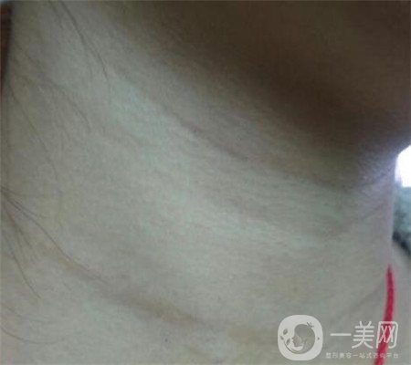 頸部除皺多少錢？會(huì)不會(huì)很貴？