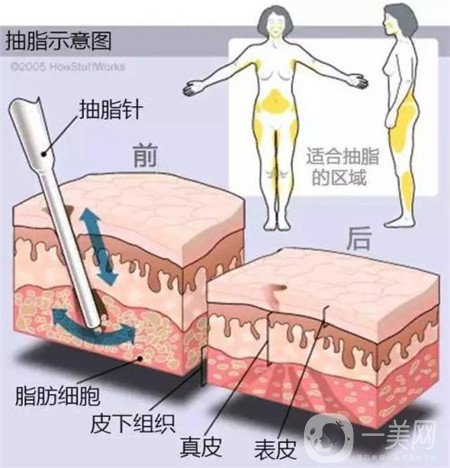 局部吸脂痛苦嗎?多久可以恢復呢?