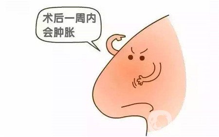 隆鼻手術(shù)恢復(fù)要多久才能自然？這期間要注意什么？