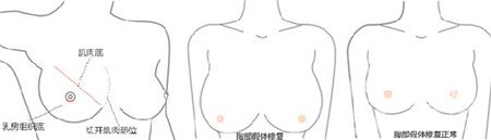 隆胸失敗之后應(yīng)該怎么處理？怎樣修復(fù)？