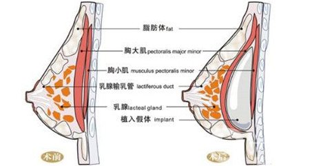 曼托假體和麥格假體哪種手感更好？教你怎么選擇？